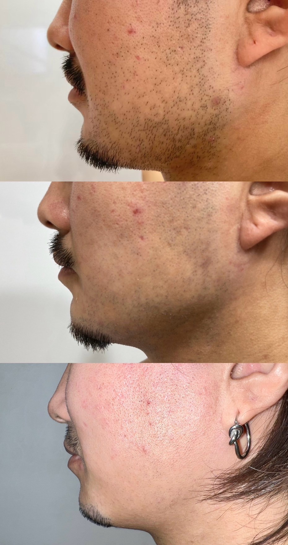 脱毛経過３段階