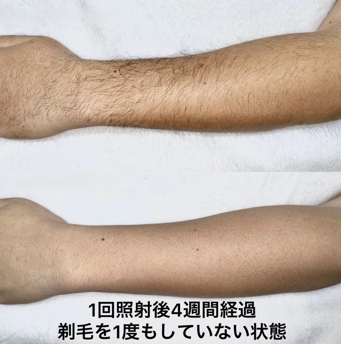 うで脱毛