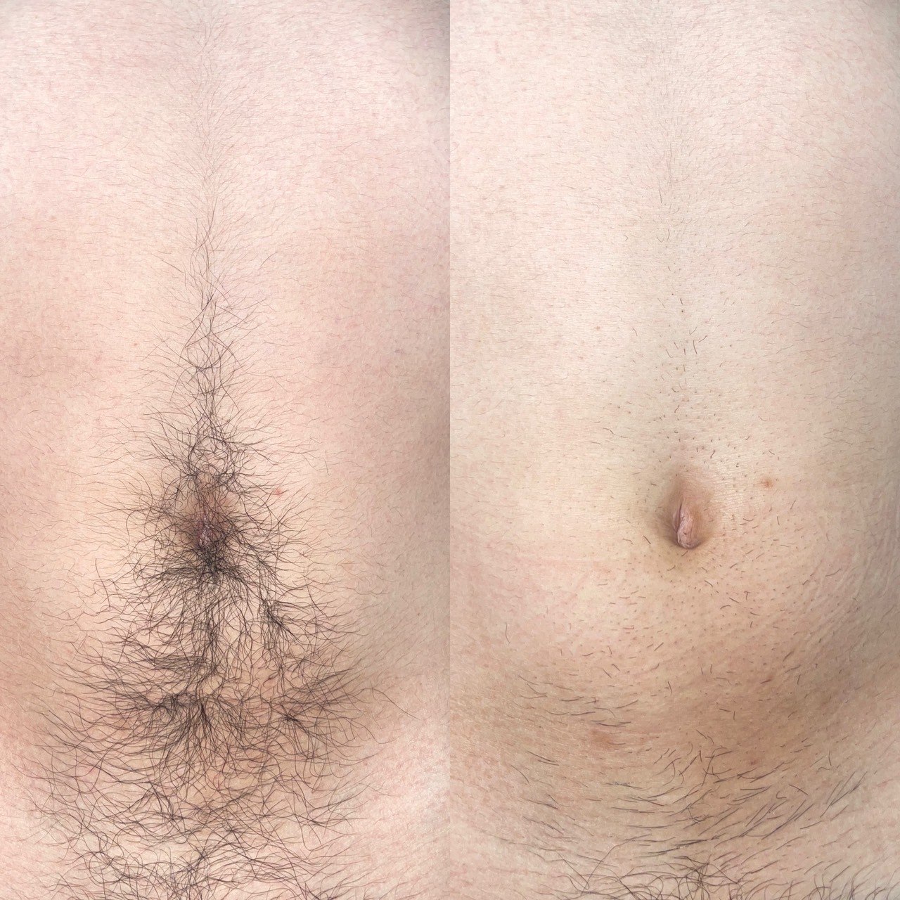 お腹脱毛