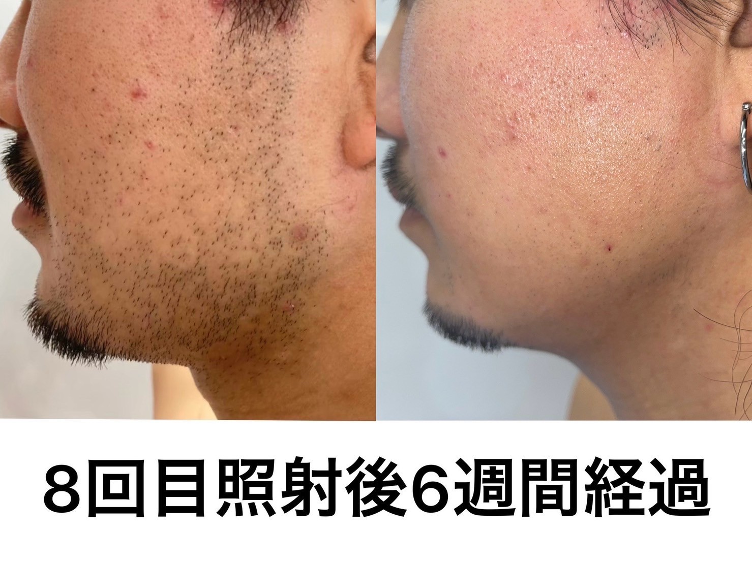 脱毛8回目後の６週間後