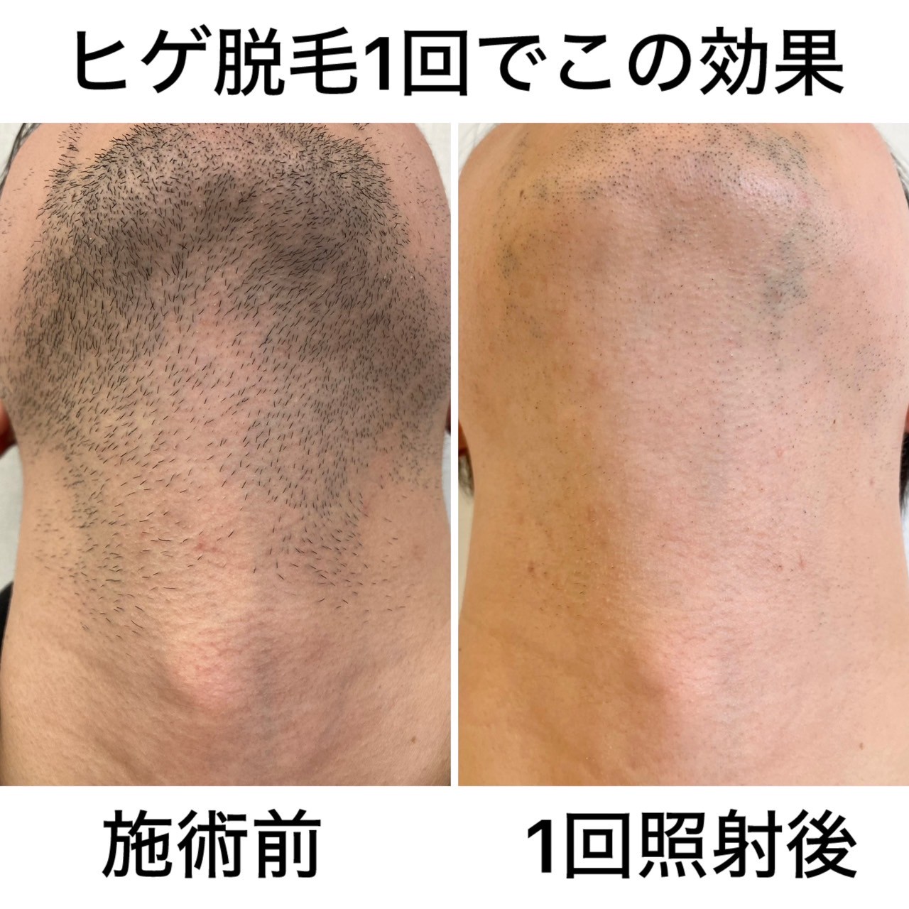 脱毛1回体験後